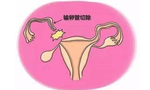 女性結(jié)扎最新方法